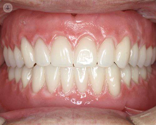 protesis-dental-completa