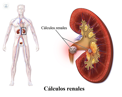 calculos-renales