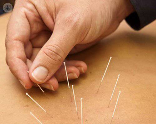 acupuntura-tratamiento-dolor