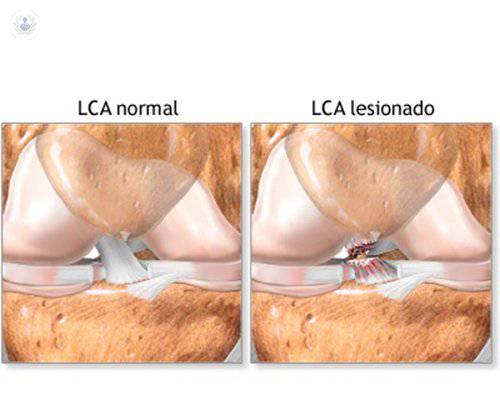 ligamento-cruzado-anterior-lca