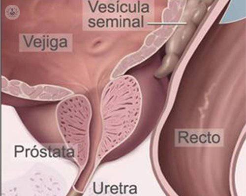 cancer-prostata-2