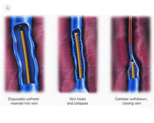 radiofrcuencia-varices