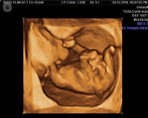 Gastrosquisis fetal: Diagnóstico prenatal precoz y tratamiento