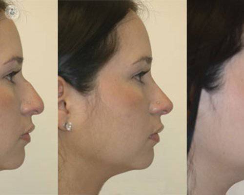 rinoplastia-antes-y-despues