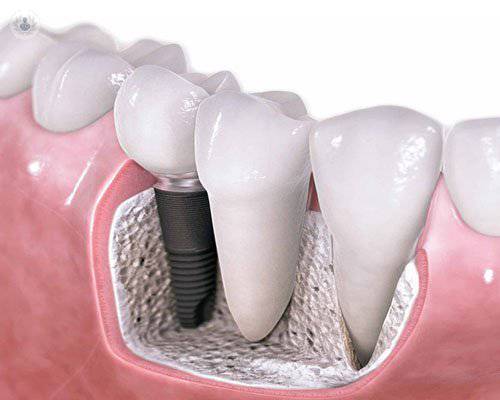 implantes-dentales-cuando-aconsejarlos