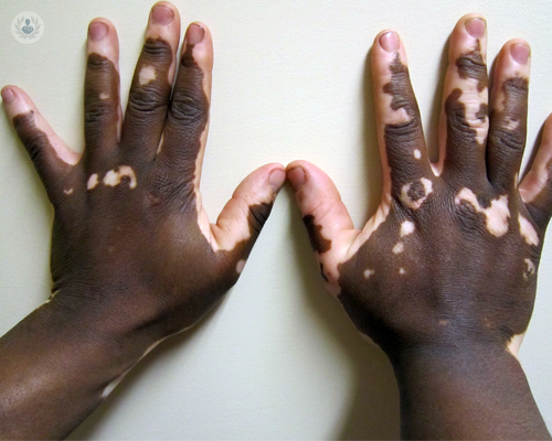 vitiligo-enfermedad-pigmentaria-de-la-piel
