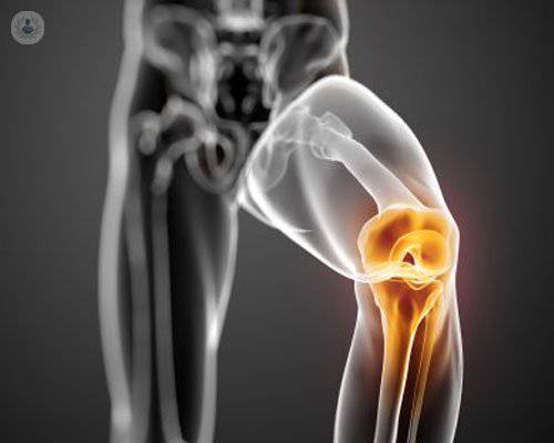 artrosis-de-rodilla