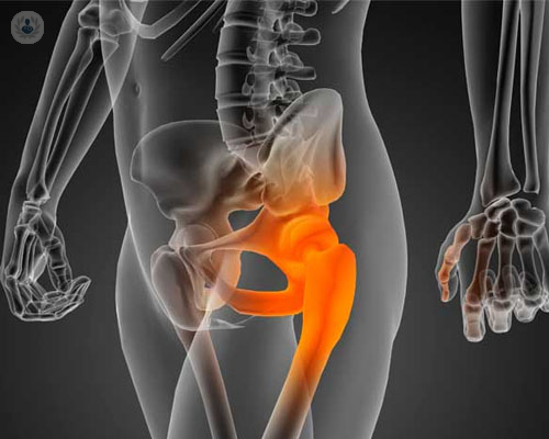 ¿Afecta la artrosis de cadera a la vida sexual?