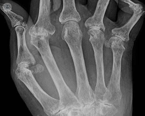 Artritis reumatoide: la importancia de buscar nuevos tratamientos
