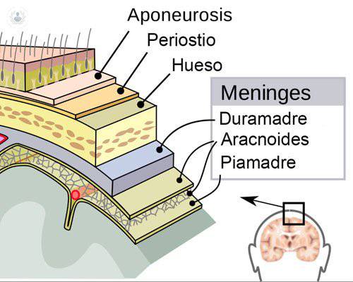 meningitis