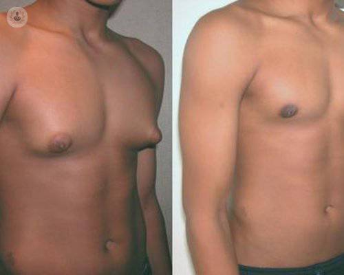 Ginecomastia: exceso de grasa en la mama de los hombres 