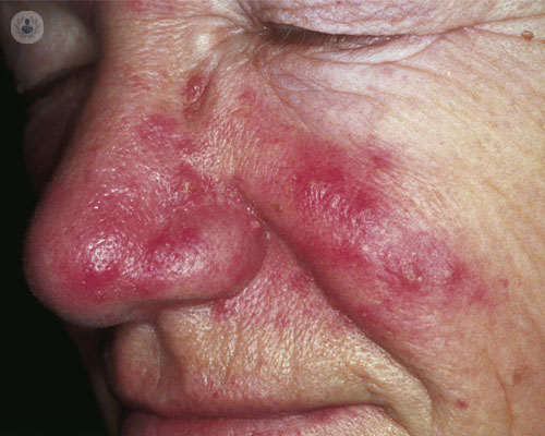 rosacea