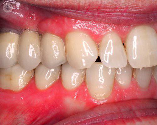 implantes-dentales
