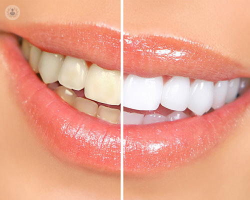 Tipos de blanqueamiento dental para una sonrisa perfecta