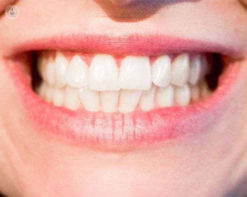 5 preguntas frecuentes sobre blanqueamiento dental