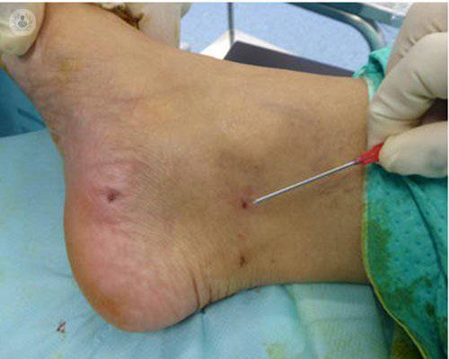 Cirugía ecoguiada ultramínimamente invasiva del síndrome del túnel tarsiano, un problema infradiagnosticado
