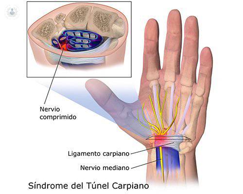 El Síndrome del Túnel Carpiano, ¿se puede prevenir?