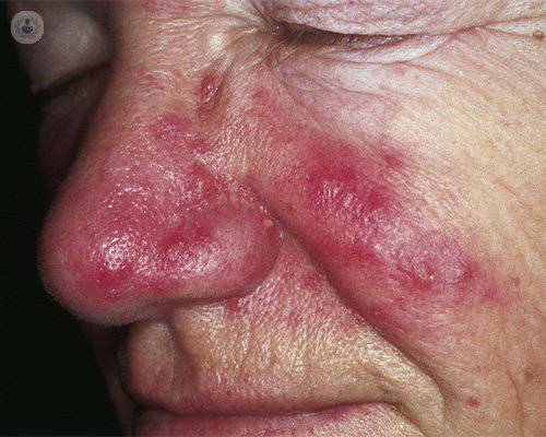rosacea-sintomas