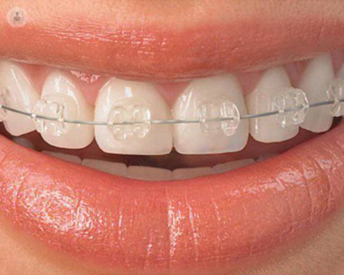 Todo lo que debes saber sobre la ortodoncia: cuándo y por qué llevarla