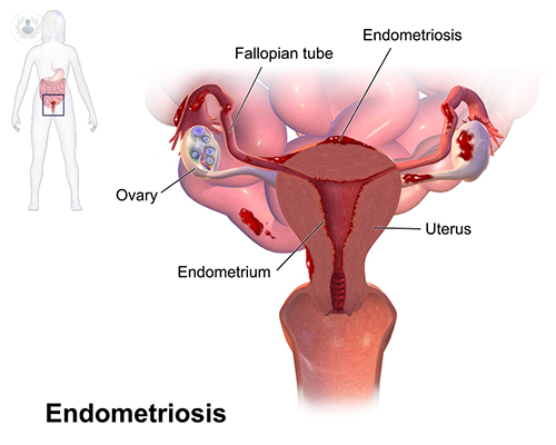 Todo sobre la endometriosis y sus efectos 