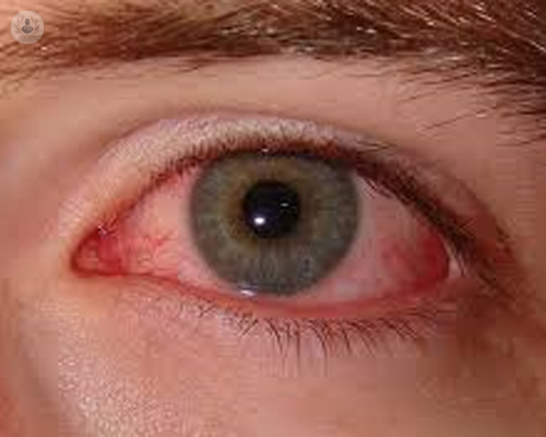 ojo-seco-diagnostico-y-tratamiento