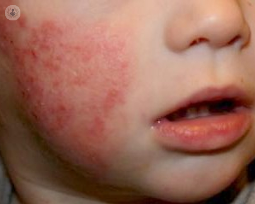 Información básica y cómo actuar ante la dermatitis atópica en la infancia