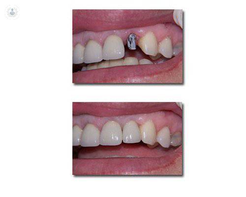 Utilidad de los implantes dentales para recuperar la función masticatoria