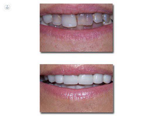 estetica-dental-resultados