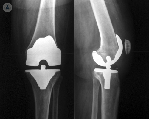 El protocolo Fast Track en la cirugía protésica de rodilla