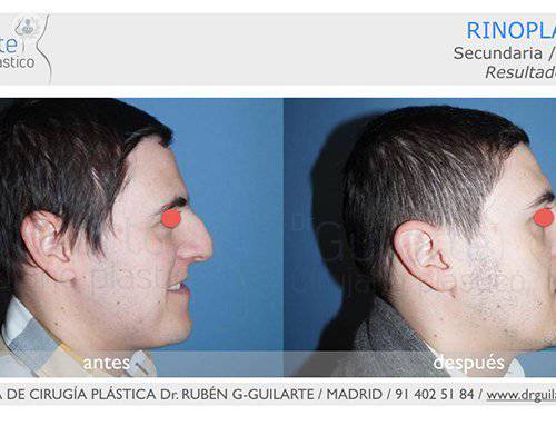 resultado-rinoplastia
