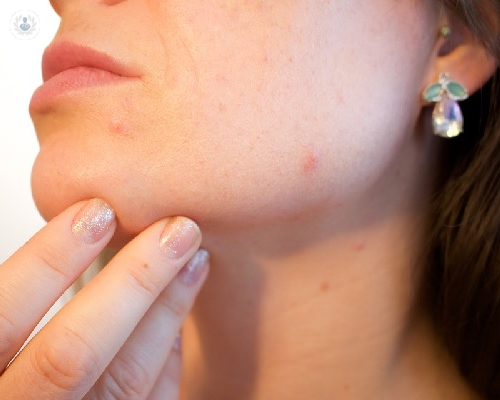 Tratamiento de las cicatrices post acné, ¿se pueden eliminar?