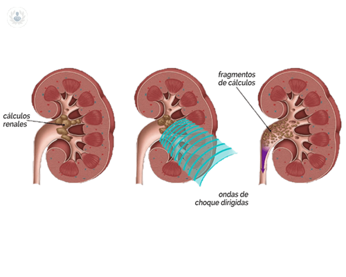 tecnicas-abordaje-colico-nefritico