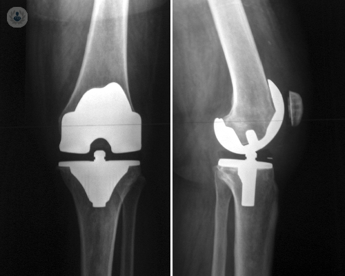 Características de la operación de la prótesis de rodilla