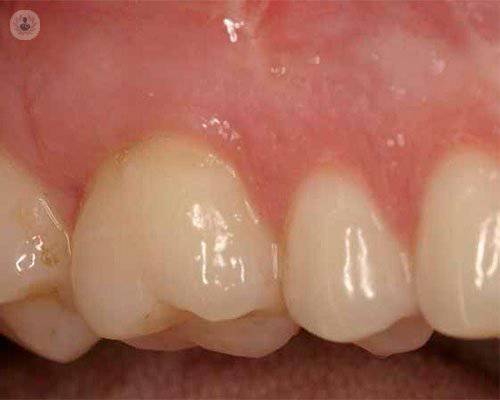 recubrimiento-de-las-recesiones