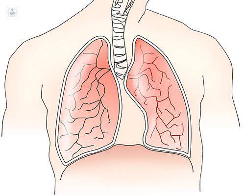 Cómo abordar el cáncer de pulmón, uno de los tumores más frecuentes