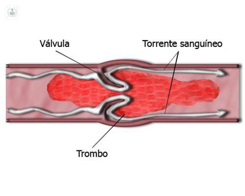 prevencion-trombosis