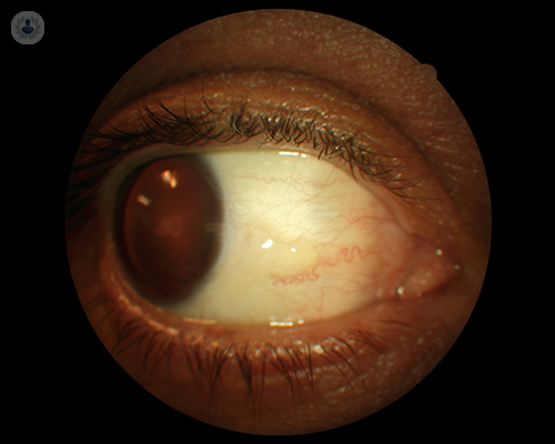 pinguecula-y-pterigion-cornea