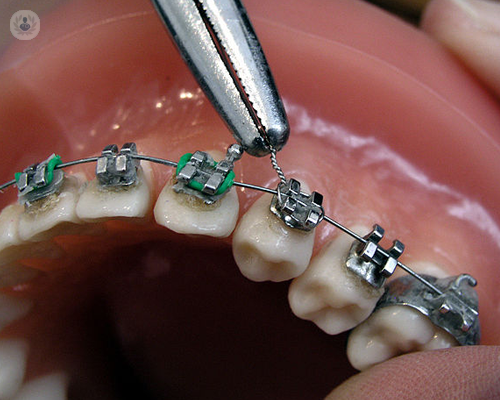 ¿Por qué más adultos llevan ortodoncia hoy?
