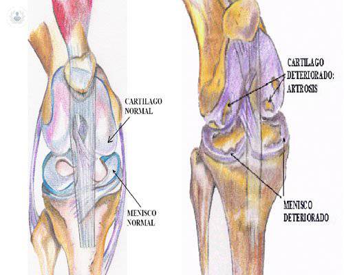 Artrosis de rodilla: síntomas y tratamiento