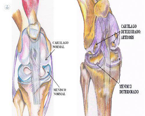 sintomas-de-la-artrosis-de-rodilla