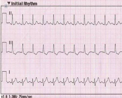 taquicardia-en-electrocardiograma