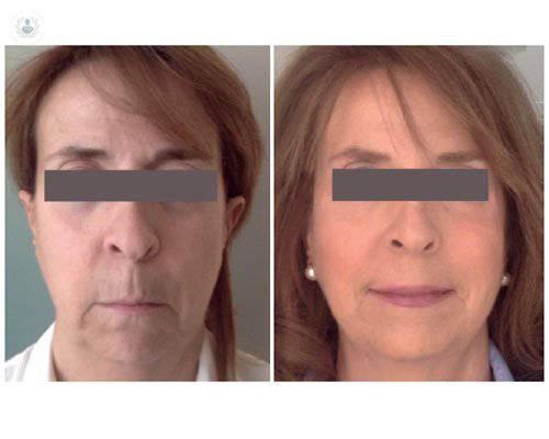 rejuvenecimiento-facial