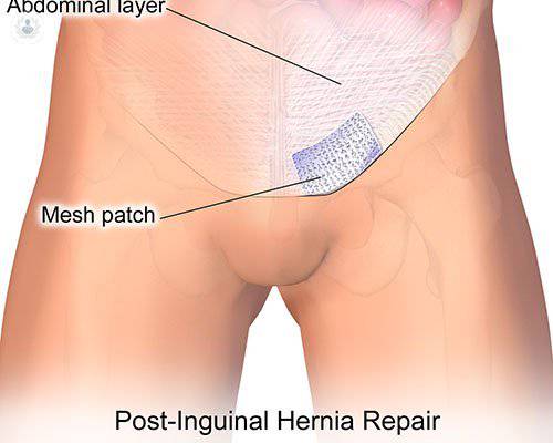 hernia-inguinal