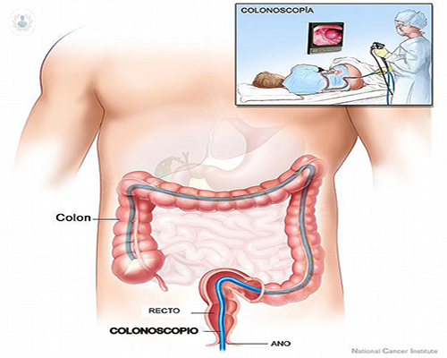 Importancia del diagnóstico precoz en el cáncer de colon
