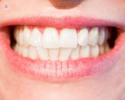 ortodoncia-retenedroes