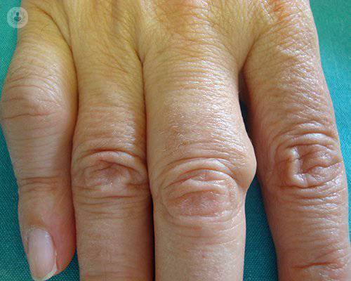 ¿Cuáles son las causas y el diagnóstico de la artritis reumatoide?
