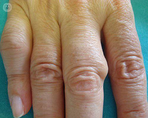 inflamacion-articular
