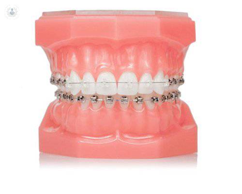 Sistema de ortodoncia Damon, dientes perfectos en menos tiempo