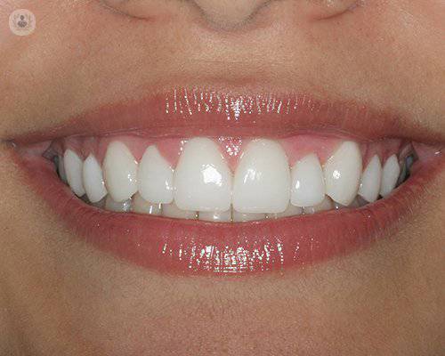 ¿Qué tipos de implantes dentales hay?