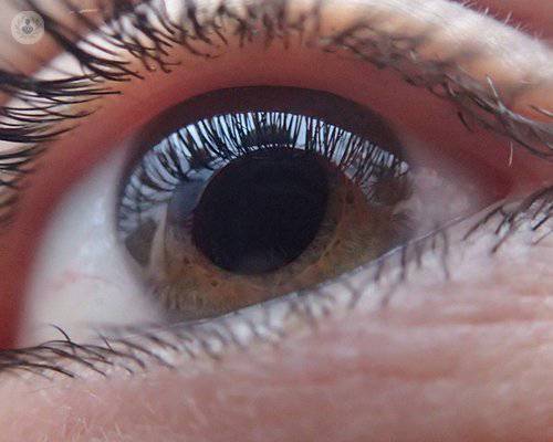 Operación ocular mediante cirugía mínimamente invasiva del glaucoma